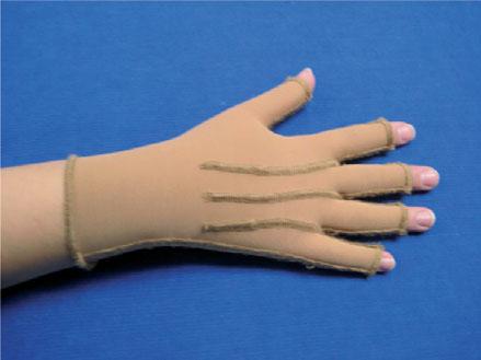 Lymphoedema Glove Light fabric, Comfortable, Micro-massaging, Available in left and right Measuring Chart for Lymphoedema Glove Small - up to 18 cms Left Right Medium - 18 to 22 cms Left Right Large