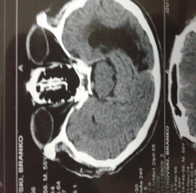 Сл. 3: Приказ на исхемичен мозочен инсулт на КТМ Figure 3: View of ischemic stroke KTM 2.