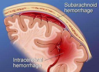 Слика 4: Видови на хеморагичен цереброваскуларен инсулт Figure 4: Types of hemorrhagic cerebrovascular stroke Најчеста причина за овој вид на Церебро-васкуларниот инсулт е руптура на анеуризма и А-V