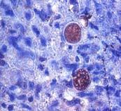Immunohistochemical stain showing positive stain for