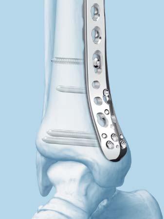 self-retaining Lengths available: 10 mm 60 mm (2 mm increments) 65 mm 95 mm (5 mm increments) Indications For fixation of fractures, osteotomies, and nonunions of the