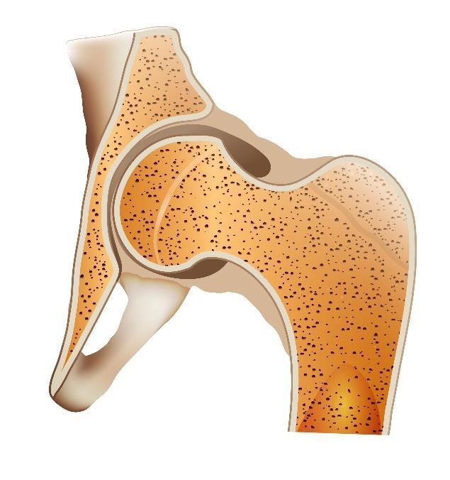 OSTEOPOROZĖ OSTEOPOROSIS. Osteoporozė atsiranda tuomet, kai organizmas netenka daug kaulų masės, gamina per mažai kaulinės medžiagos arba abiem atvejais.