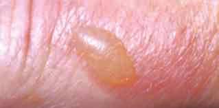 unbroken skin over blister intact Keep covered to prevent infections