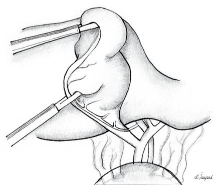 Junij 2015 73 Iz zgodovine medicine Moderni instrumenti, ki jih danes uporabljamo za laparoskopsko holecistektomijo. Vir: Oddelek za abdominalno in splošno kirurgijo, UKC Maribor.
