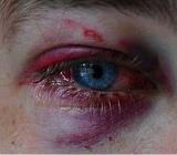 Eye Injuries Splashing grease