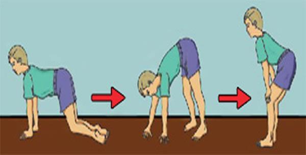 Pojavljuje se Gowersov znak - tipični dijagnostički znak, označava uspinjanje po vlastitom tijelu iz sagnutog položaja - bolesnik se rukama hvata za svoje noge i tako uspravlja.