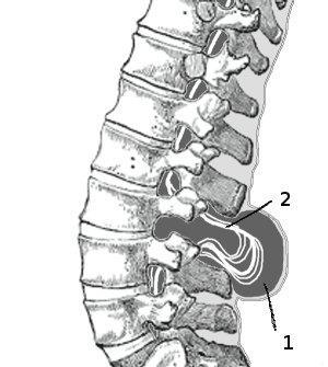 Spina bifida cistična (cystica) (na leđima vidljiva vreća ili mjehur prekriven tankim slojem kože) Mijelomeningokela najteži je i najučestaliji oblik spine bifide.