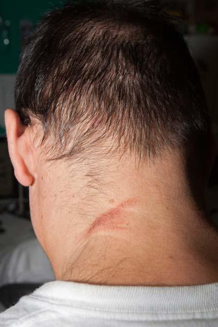 Welts on Nicholas's neck that he says came from Thomas Crowe strangling him in a bed of flowers (courtesy JB Nicholas) Holland says he told several police officers what happened, and one took down