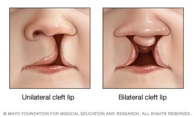 What is a Cleft The most common birth difference that occurs in the U.S.